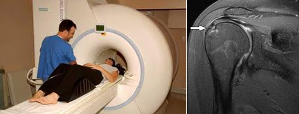 MRI Scan for Shoulder Injury