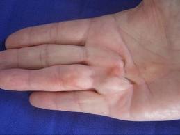 Early Dupytren's Contracture