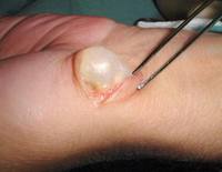 A fluid filled ganglion being removed.