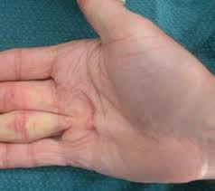 Moderate Dupytren's Contracture